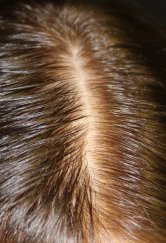 PRP Hair 1 - Before Treatment